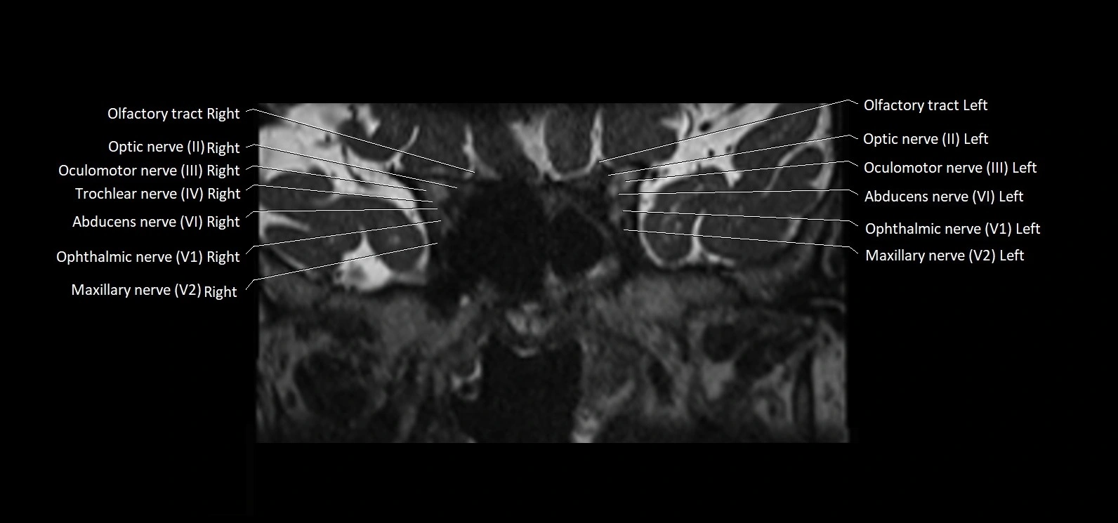 Cranial nerve cross sectional anatomy coronal 3T MRI image 20.webp
